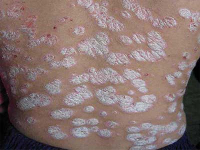 怎么才能防止銀屑病患病面積擴