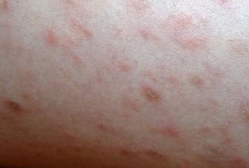 張英醫生指點春季銀屑病患者出