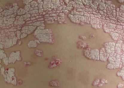 彭安明醫生講述銀屑病患者春季