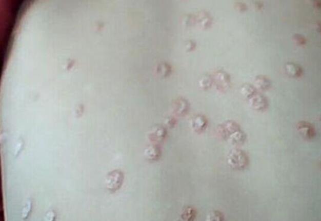 在線咨詢張英醫生：銀屑病患者何