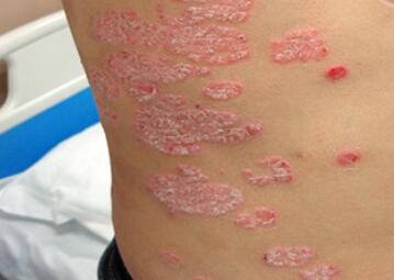 這個春季和銀屑病說拜拜-銀友