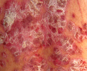 青少年被銀屑病魔糾纏會有怎樣