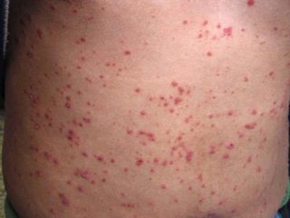 得了銀屑病有哪些典型的癥狀表現